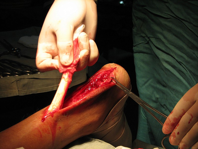 After effects of steroid injection in heel